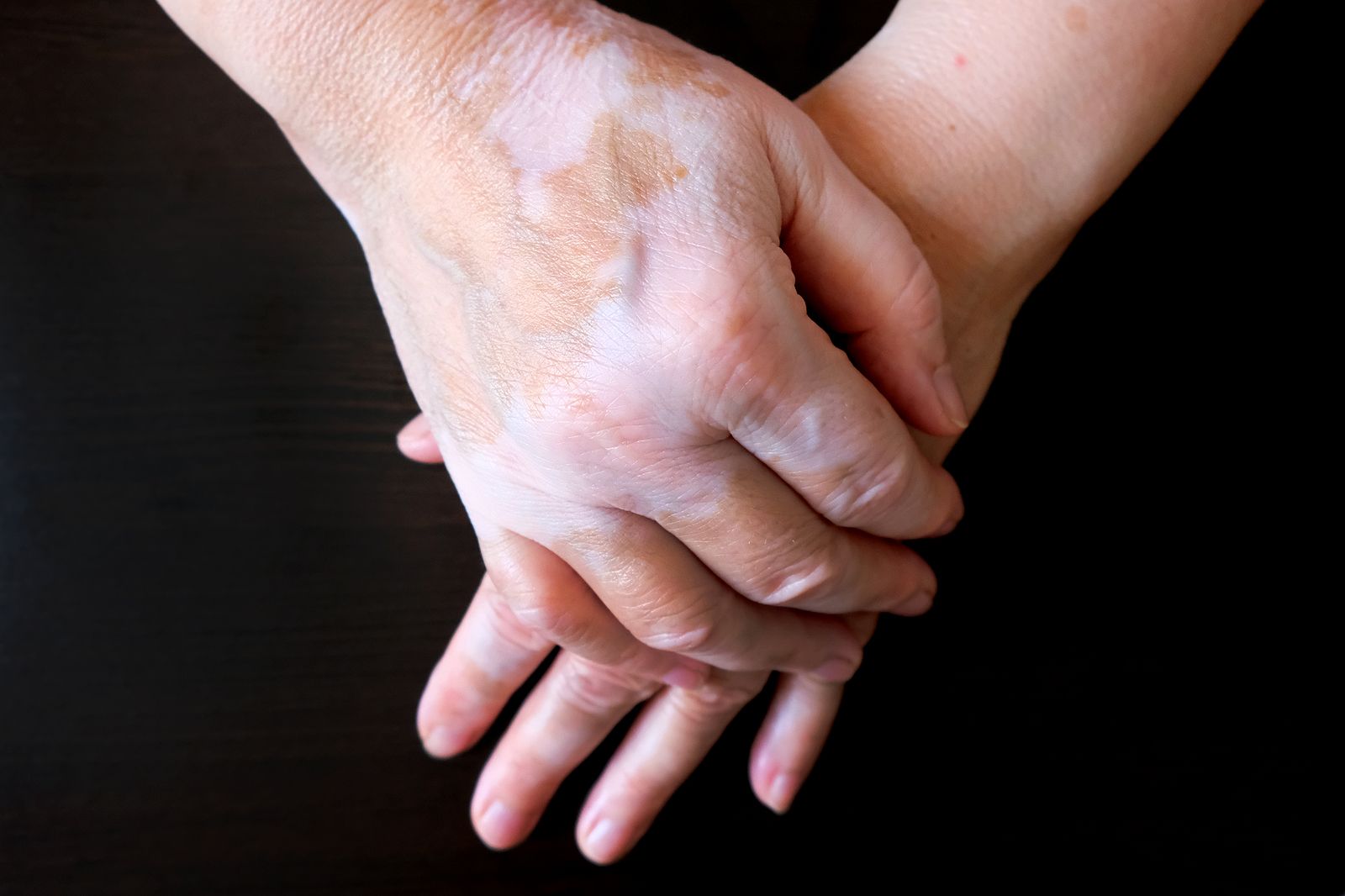 ¿Qué es el vitiligo?