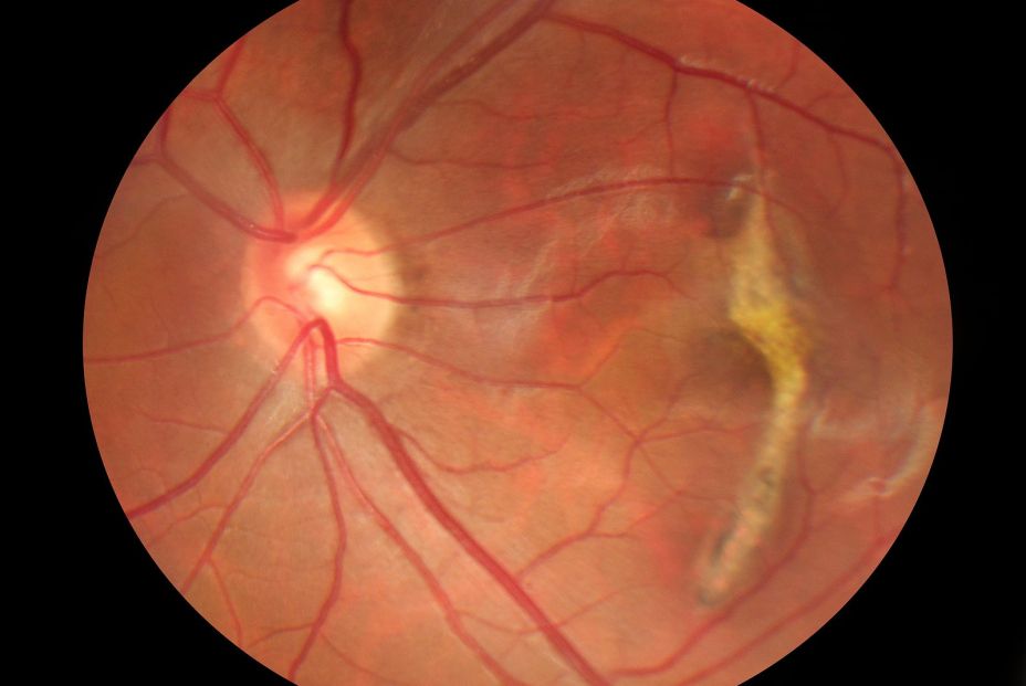 Degeneración macular Asociada a la Edad (DMAE)
