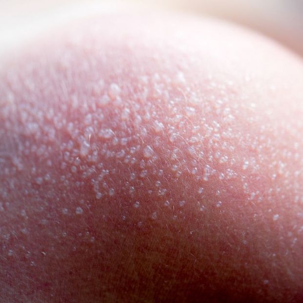 quemadura solar quemadura solar