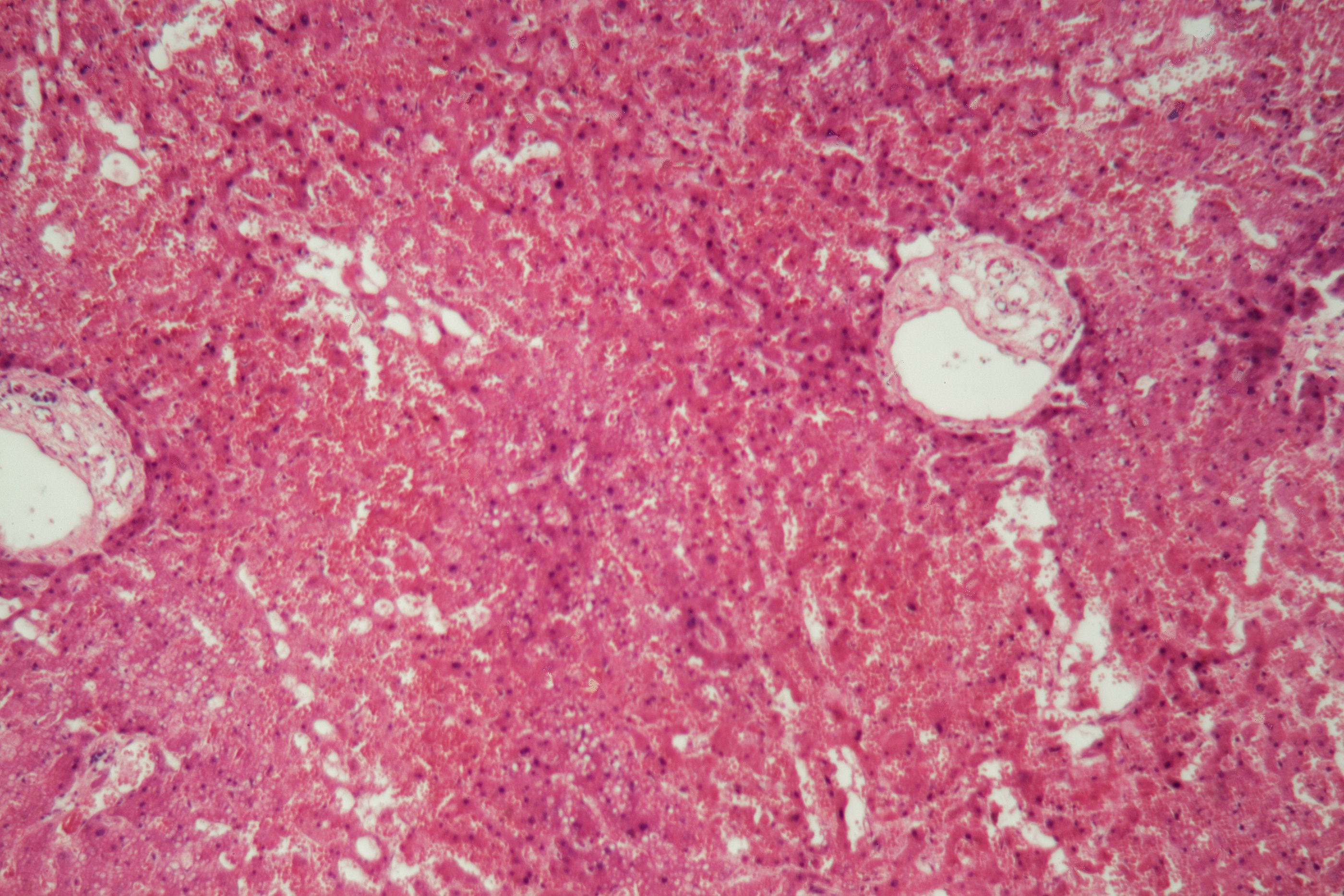 Amiloidosis, una enfermedad rara sin cura