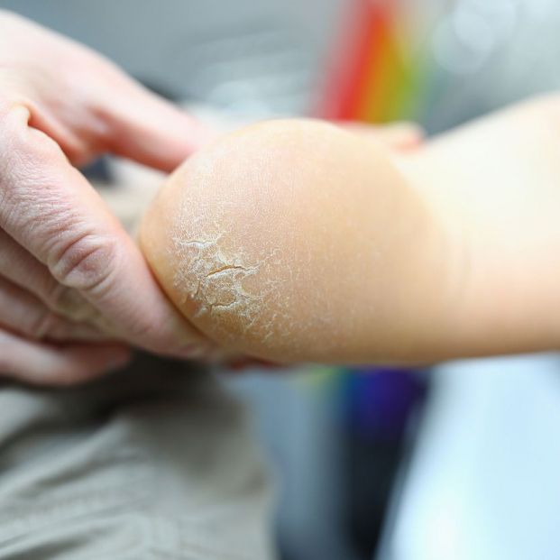 hiperqueratosis o durezas en los pies hiperqueratosis o durezas en los pies