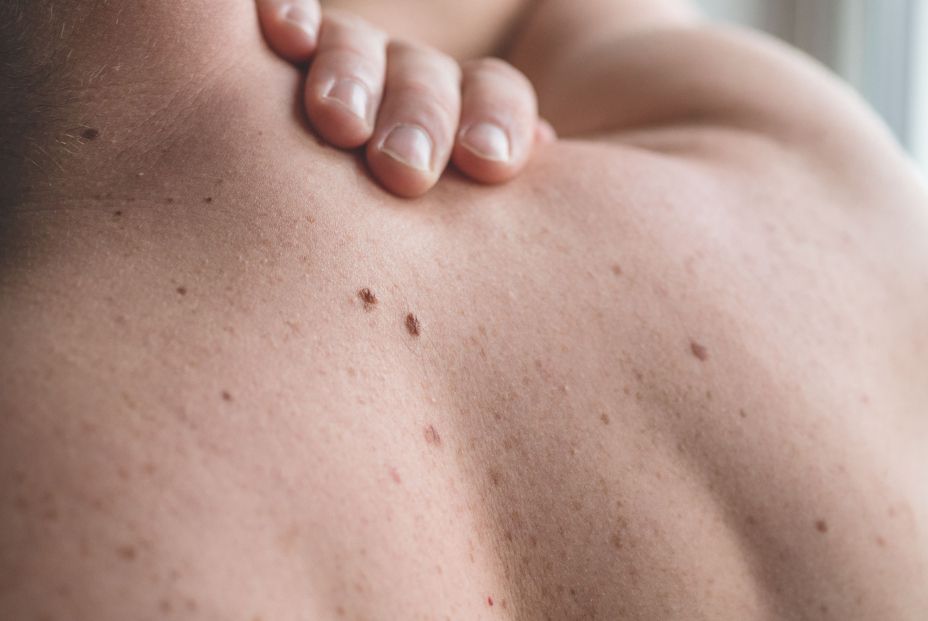 Ramón Sánchez-Ocaña: El aumento del cáncer de piel Ramón Sánchez-Ocaña: El aumento del cáncer de piel