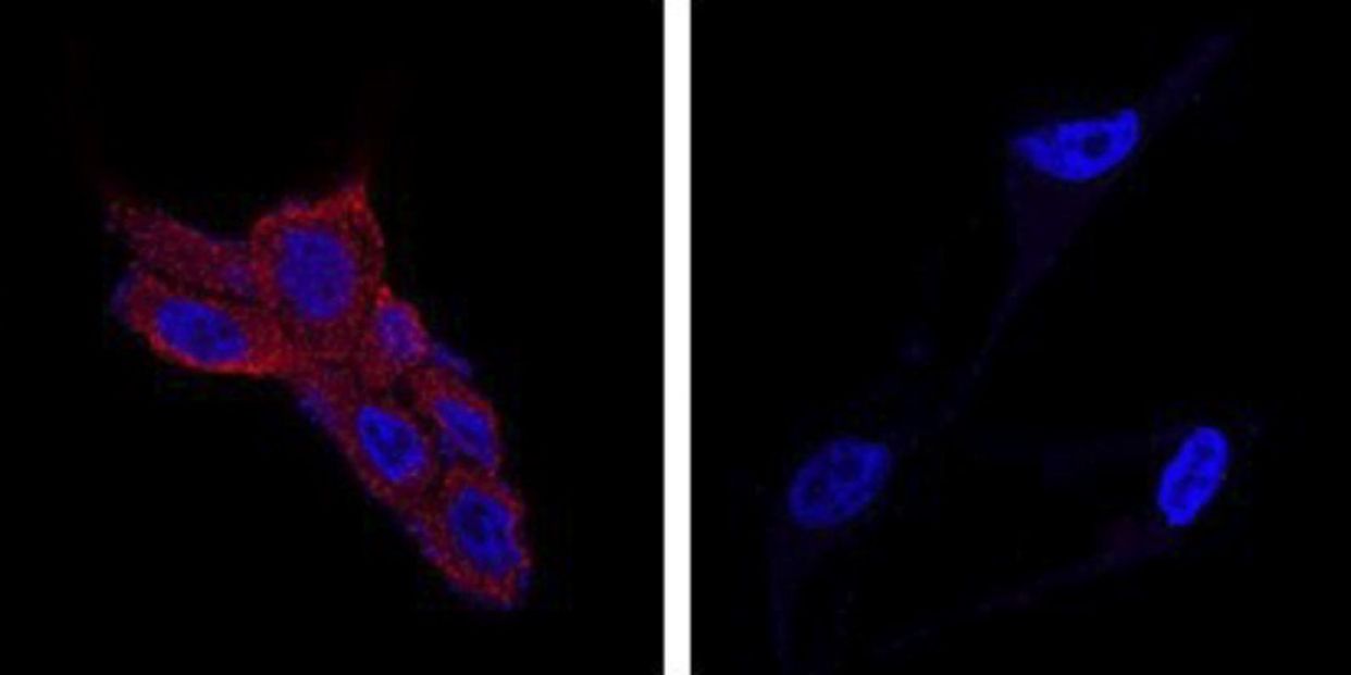 cancer prostata cancer prostata