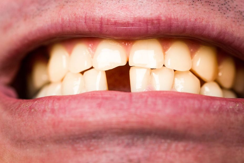 bigstock Yellow Bad Teeth Man Without305227432 bigstock Yellow Bad Teeth Man Without305227432