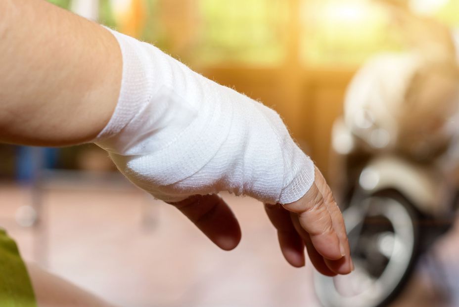 Alertan sobre el riesgo de necrosis en la mano en pacientes con coronavirus