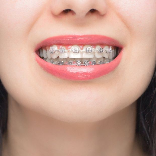 ¿Pensando en arreglar tus dientes? Estos son los tipos de ortodoncia existentes Foto: bigstock ¿Pensando en arreglar tus dientes? Estos son los tipos de ortodoncia existentes Foto: bigstock