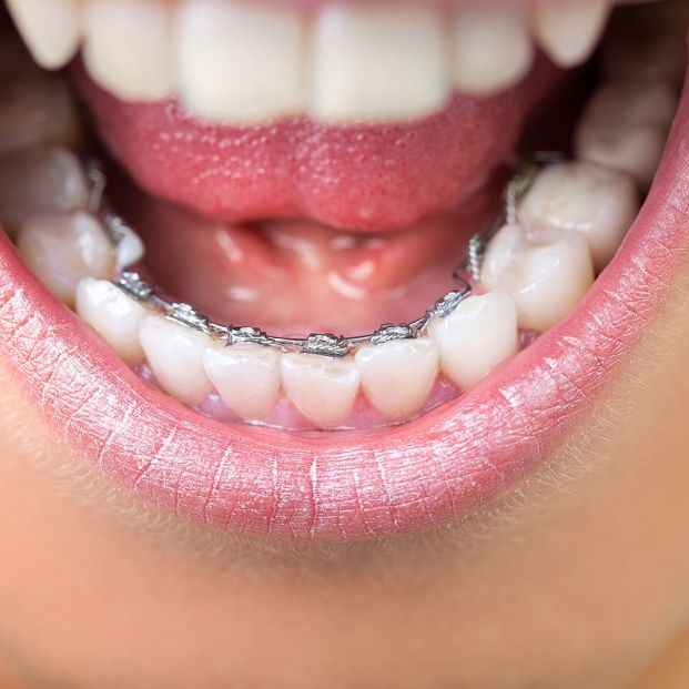 ¿Pensando en arreglar tus dientes? Estos son los tipos de ortodoncia existentes Foto: bigstock ¿Pensando en arreglar tus dientes? Estos son los tipos de ortodoncia existentes Foto: bigstock