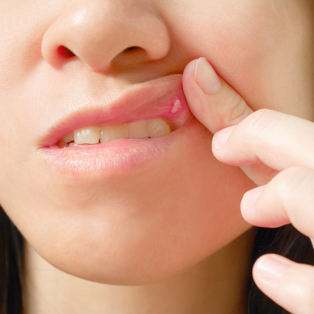 Bigstock Llagas en la boca: cómo aliviarlas Bigstock Llagas en la boca: cómo aliviarlas