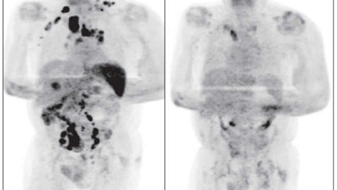 Comparación de la tomografía por emisión de positrones (PET) al inicio (izquierda) y después de meses infectado con SARS-CoV-2 (derecha). FotoBritish Journal of Haemathology Comparación de la tomografía por emisión de positrones (PET) al inicio (izquierda) y después de meses infectado con SARS-CoV-2 (derecha). FotoBritish Journal of Haemathology