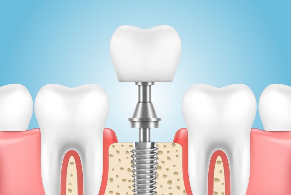 ¿Qué son las prótesis dentales? ¿Cuál debo elegir? (bigtstock) ¿Qué son las prótesis dentales? ¿Cuál debo elegir? (bigtstock)