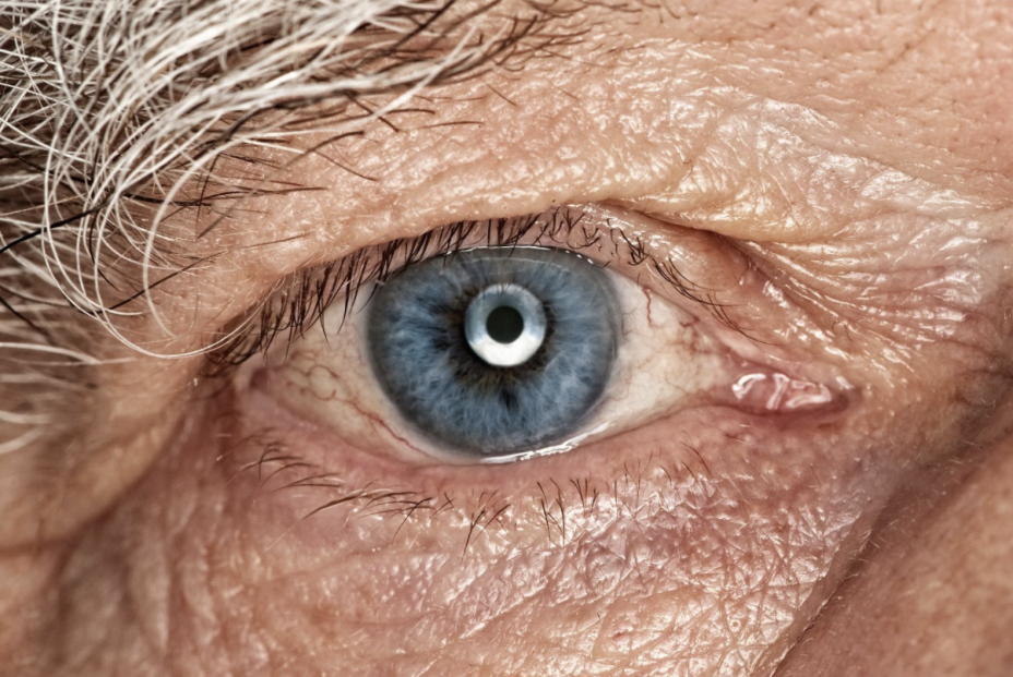 Degeneración macular Degeneración macular