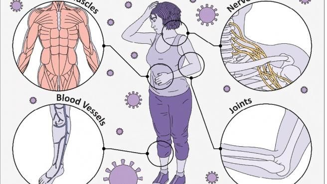 Imagen del estudio desarrollado por la Universidad de Northwestern sobre síntomas de la covid. FuenteUniversidad de Northwestern