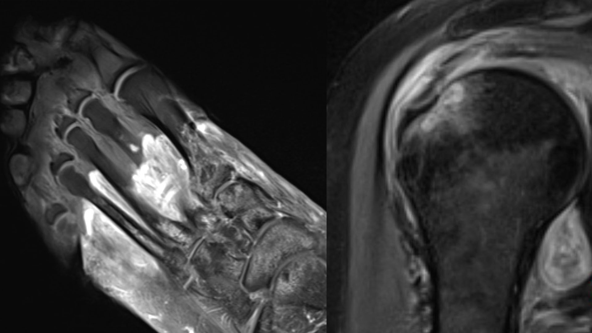 Artritis, gangrena, coágulos, hematomas, nervios lesionados... síntomas raros del covid persistente