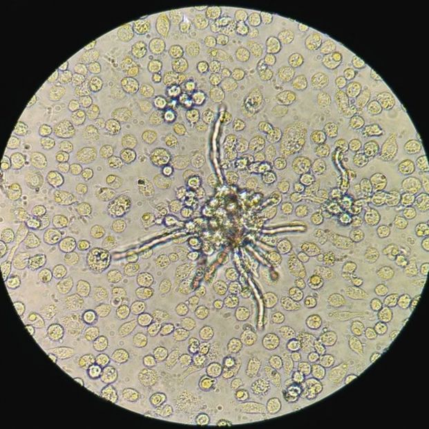 El 'hongo negro', la amenaza silenciosa que afecta a algunos infectados de Covid-19 en la India. Foto: Europa Press El 'hongo negro', la amenaza silenciosa que afecta a algunos infectados de Covid-19 en la India. Foto: Europa Press