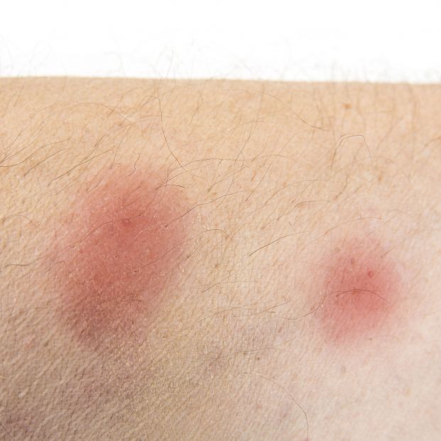 bigstock Bites Of Insect On Male Body243834367 bigstock Bites Of Insect On Male Body243834367