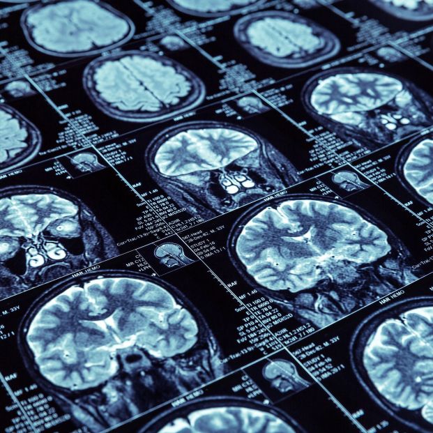 Baja la incidencia del alzhéimer sin haber encontrado una cura: estos son los motivos Baja la incidencia del alzhéimer sin haber encontrado una cura: estos son los motivos