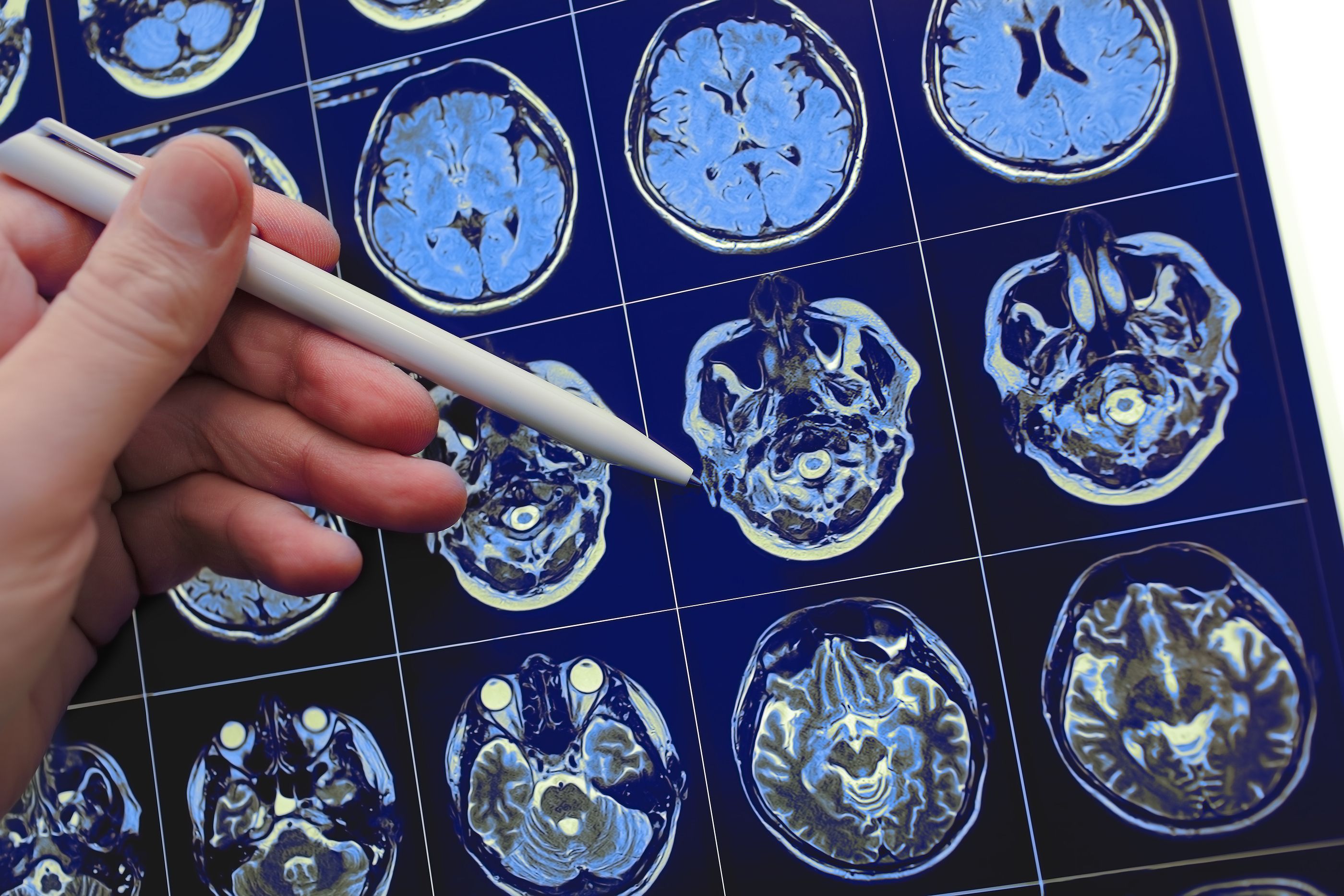 Investigadores descubren el gen regulador del cáncer cerebral con peor pronóstico. FOTO: Bigstock 