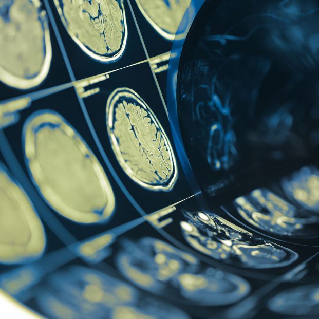 Investigadores descubren el gen regulador del cáncer cerebral con peor pronóstico. FOTO: Bigstock Investigadores descubren el gen regulador del cáncer cerebral con peor pronóstico. FOTO: Bigstock