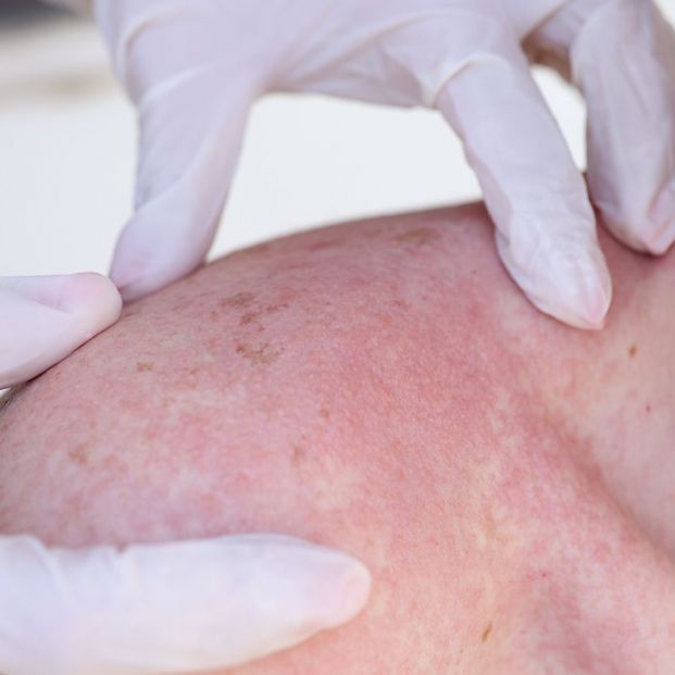 bigstock Los riesgos de una quemadura solar bigstock Los riesgos de una quemadura solar