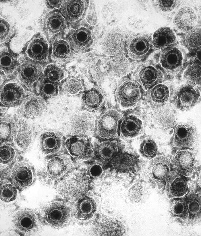 Descubren un nuevo antiviral contra el herpes simple resistente a los tratamientos