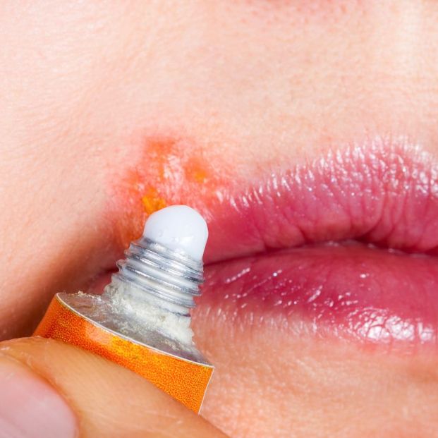 bigstockTratamiento herpes labial bigstockTratamiento herpes labial