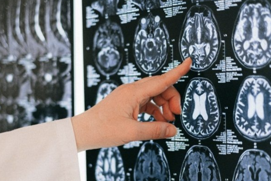 Descubren una de las causas del párkinson que podría revolucionar las terapias. Foto: Europa Press Descubren una de las causas del párkinson que podría revolucionar las terapias. Foto: Europa Press