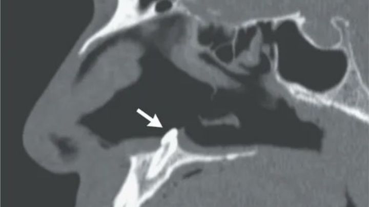 Un hombre con problemas para respirar acude al médico y le encuentran un diente en la nariz (Twitter) Un hombre con problemas para respirar acude al médico y le encuentran un diente en la nariz (Twitter)