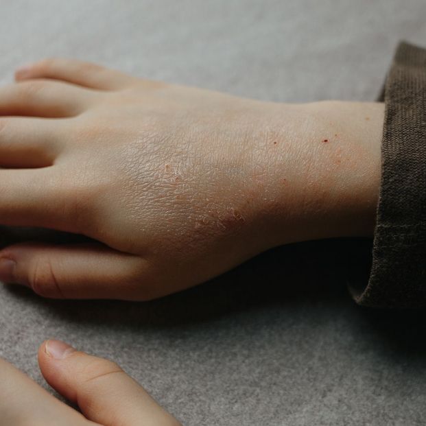 erupcion sarpullido mano niño erupcion sarpullido mano niño