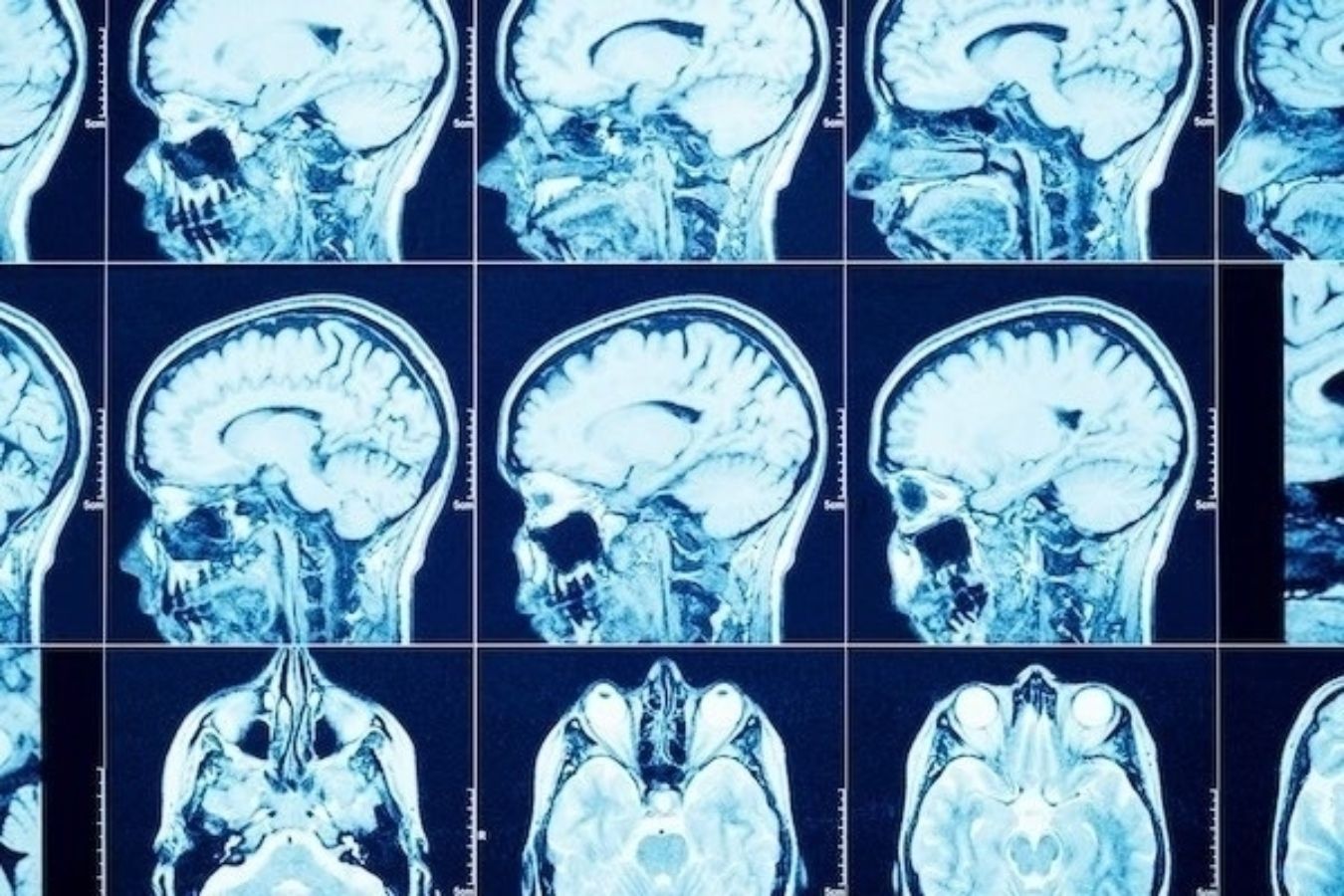 Antirretrovirales contra el VIH podrían ser eficaces frente a tumores cerebrales, según un estudio