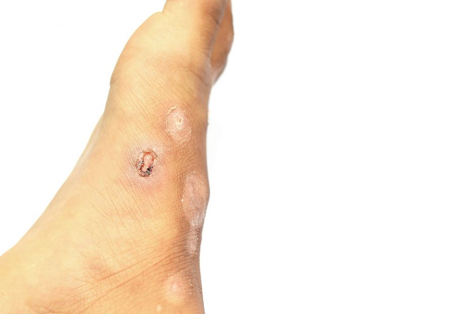 Sarna. Qué se sabemos de esta enfermedad que afecta a la piel 3 Sarna. Qué se sabemos de esta enfermedad que afecta a la piel 3