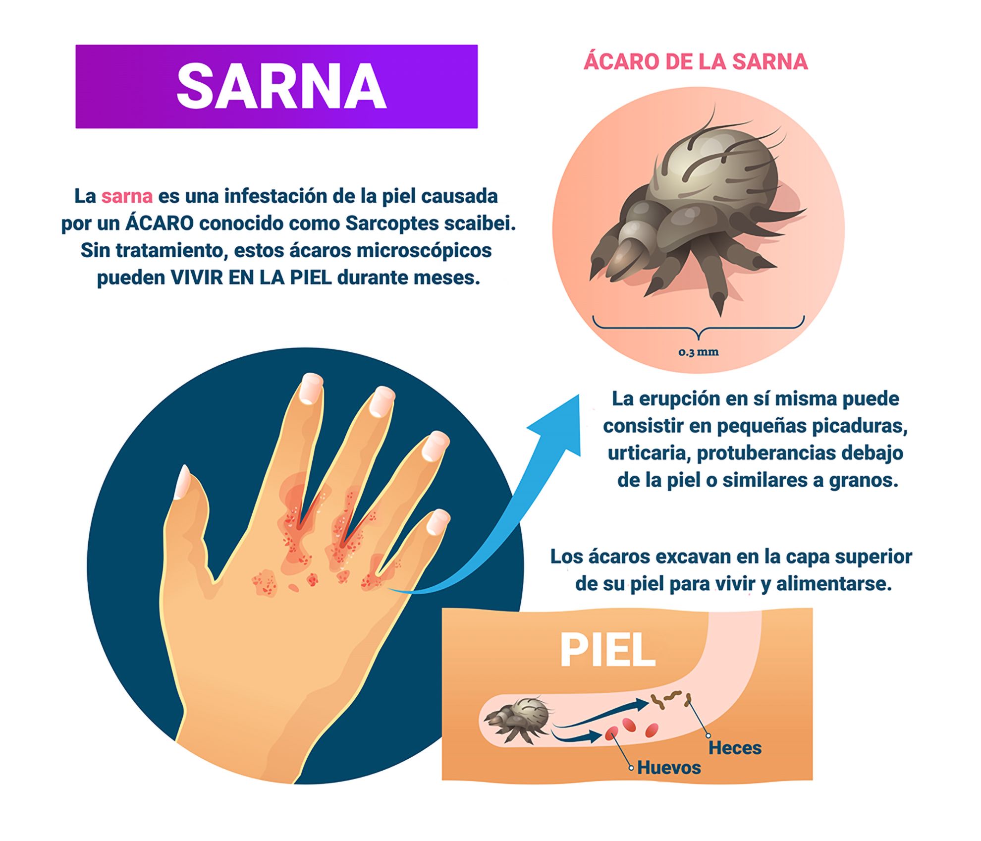 Sarna. Qué se sabemos de esta enfermedad que afecta a la piel 6 Sarna. Qué se sabemos de esta enfermedad que afecta a la piel 6