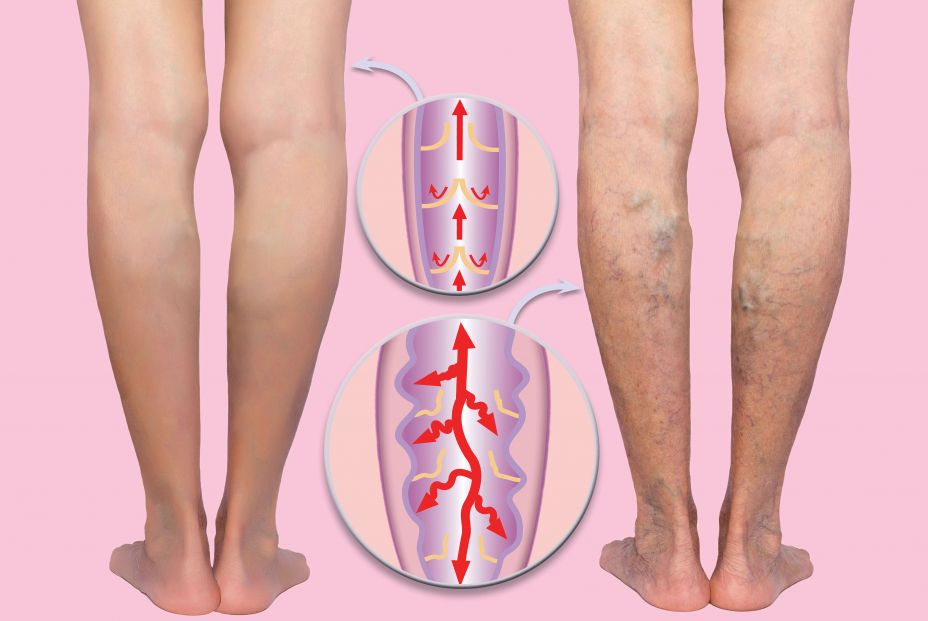 Piernas con varices y sin varices (bigstock) Piernas con varices y sin varices (bigstock)