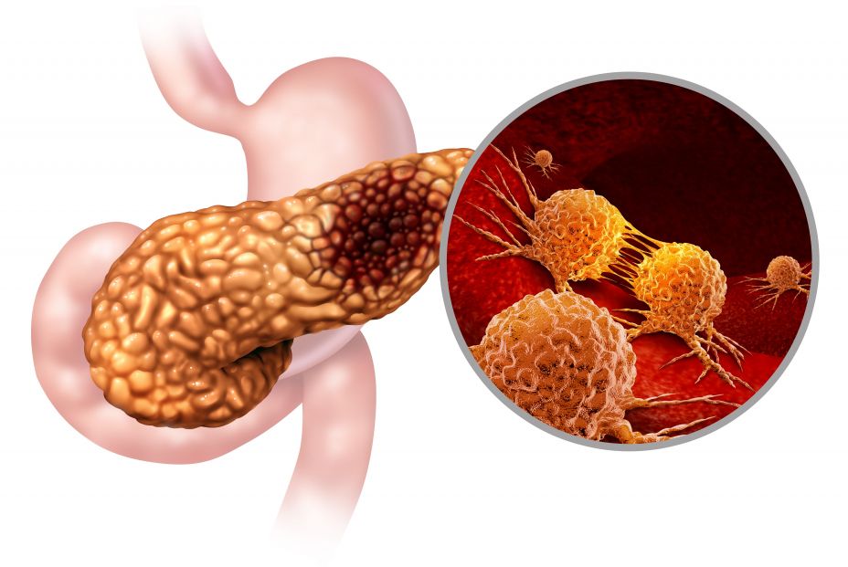 Cáncer páncreas Cáncer páncreas