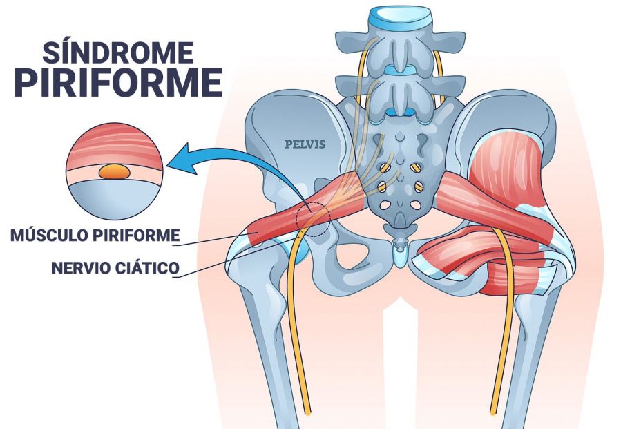 La falsa ciática. Un dolor muscular incapacitante La falsa ciática. Un dolor muscular incapacitante